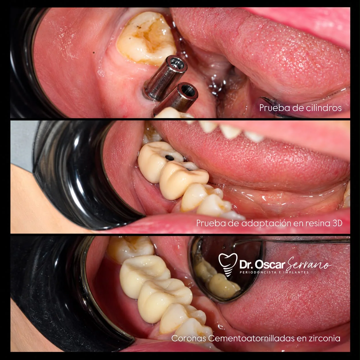 Secuencia clínica de rehabilitación posterior con implantes, pruebas de cilindros, prueba en resina y coronas cementatornilladas de zirconia.