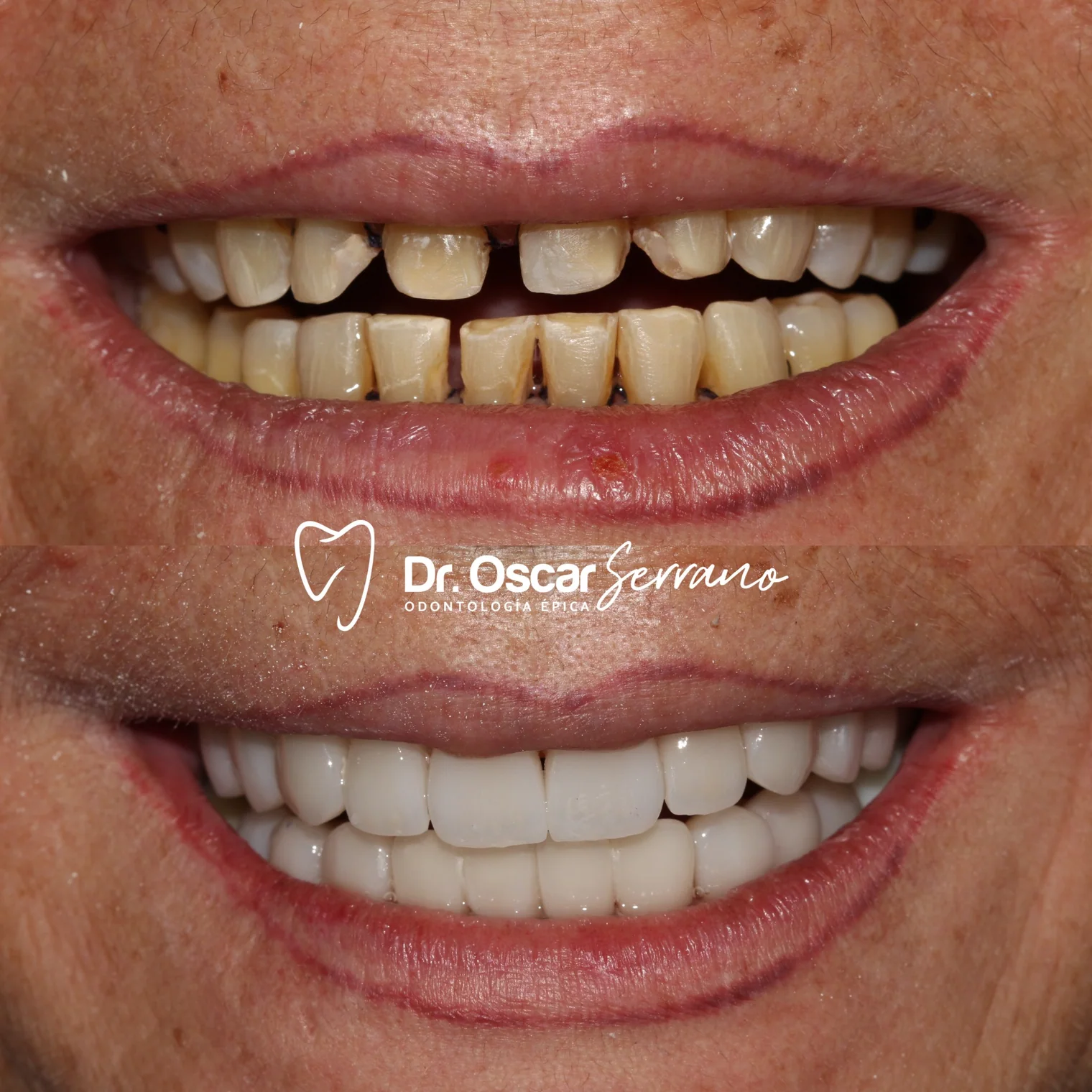 Antes y después de una sonrisa rehabilitada mediante restauraciones cerámicas de disilicato.