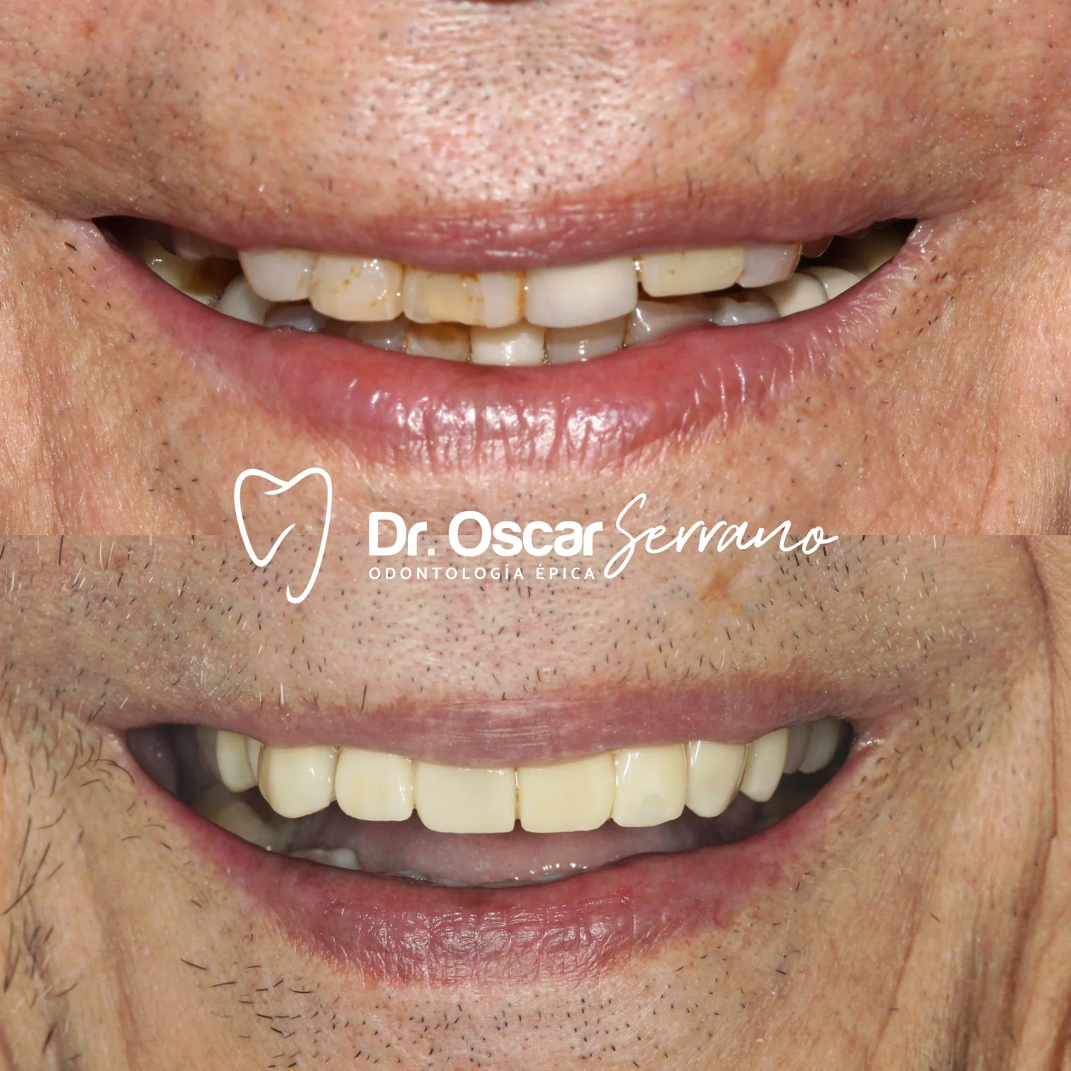 Fotografías clínicas de sonrisa y sector anterior de un tratamiento combinado con carillas cerámicas e implantes dentales.