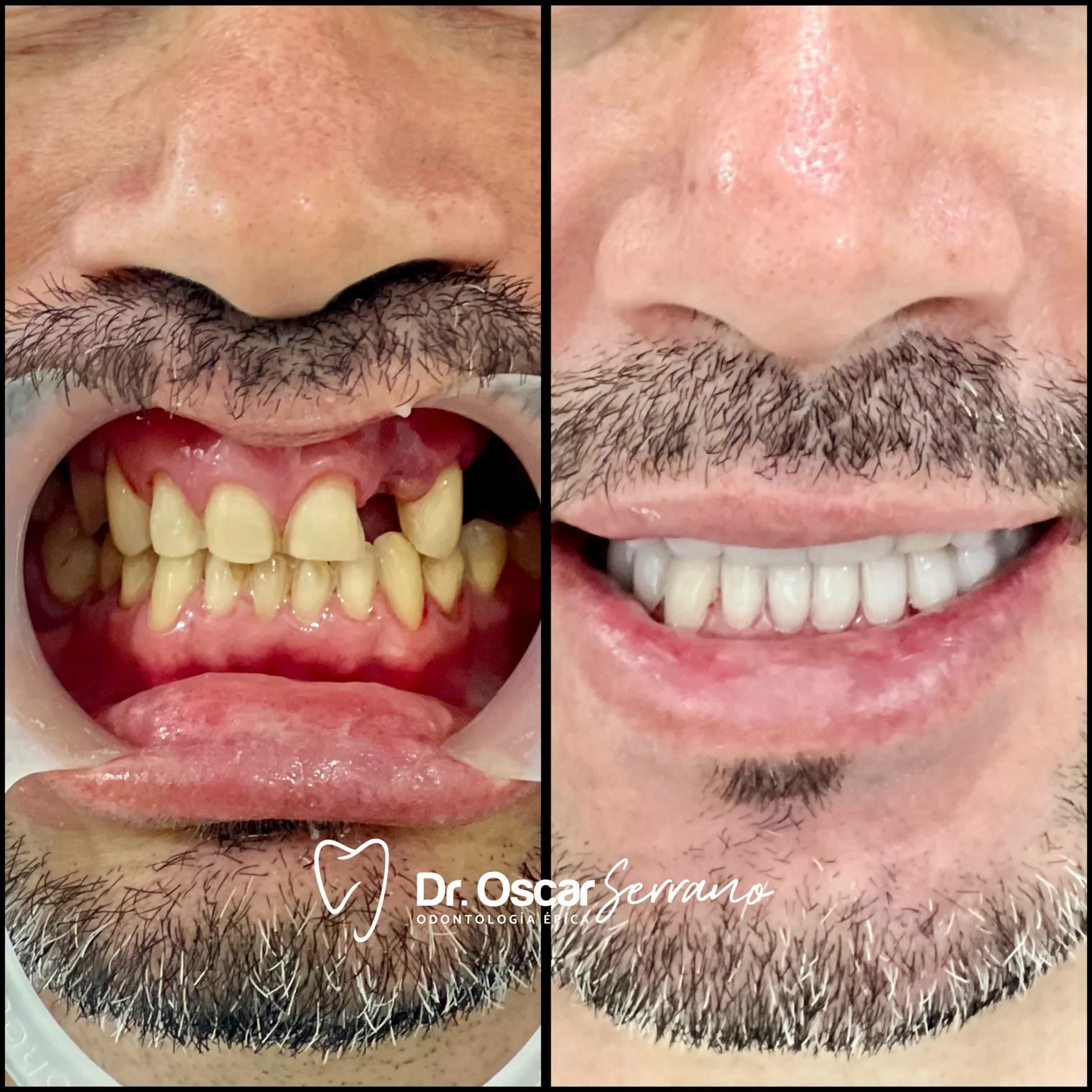 Comparación clínica del resultado de un tratamiento combinado con carillas de disilicato de litio y un implante dental.