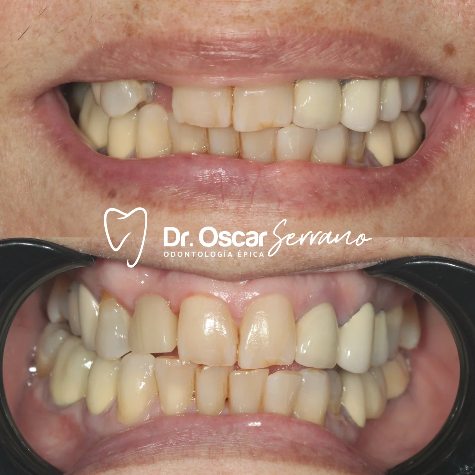 Comparación de sonrisa antes y después de la rehabilitación de un espacio dental con implante.